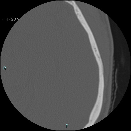 Cholesterol granuloma of the petrous apex (Radiopaedia 64358-73141 Axial bone window 12).jpg