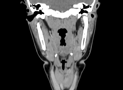 Chondroblastic osteosarcoma (Radiopaedia 67363-76741 D 66).jpg