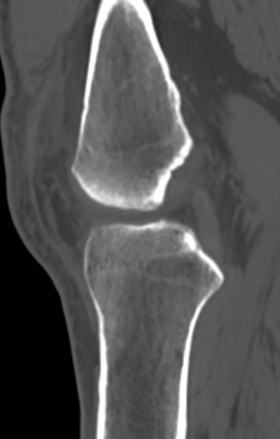 Chondrocalcinosis (Radiopaedia 82862-97173 Sagittal bone window 29).jpg