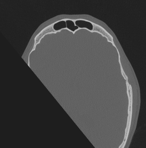 File:Chondrosarcoma (clivus) (Radiopaedia 46895-51425 Axial bone window 3).png