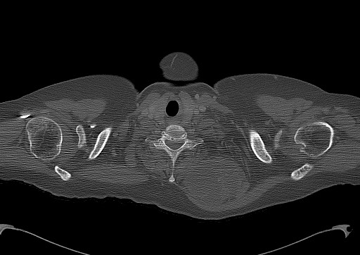 File:Chondrosarcoma - chest wall (Radiopaedia 65192-74199 Axial bone window 5).jpg