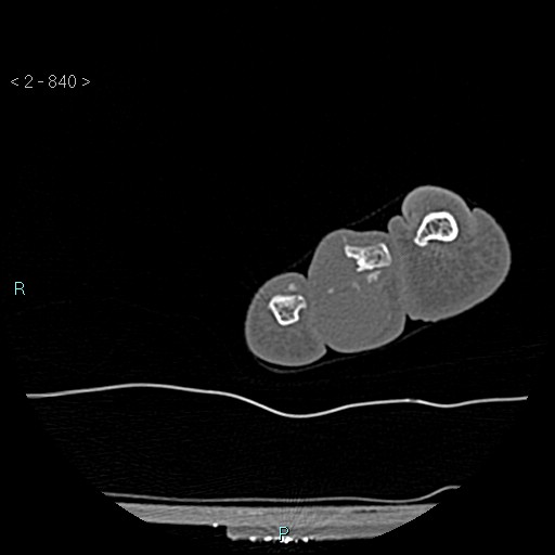 Chondrosarcoma - phalanx (Radiopaedia 69047-78812 Axial bone window 94).jpg