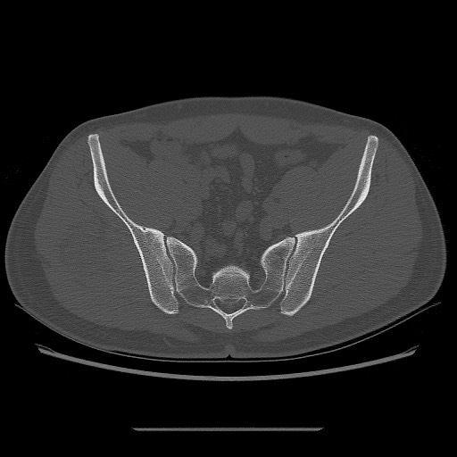 File:Chondrosarcoma of iliac wing (Radiopaedia 63861-72599 Axial bone window 65).jpg