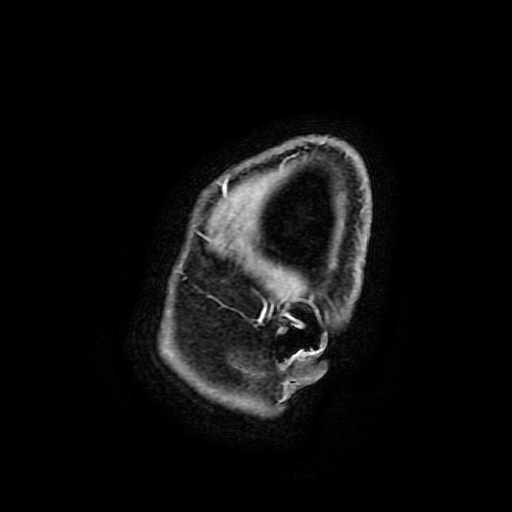 Chordoid glioma of third ventricle (Radiopaedia 91612-109340 F 197).jpg