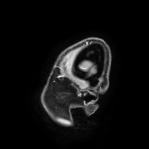 File:Chordoid glioma of third ventricle (Radiopaedia 91612-109340 F 21).jpg