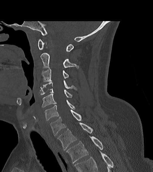 File:Chordoma (C4 vertebra) (Radiopaedia 47561-52188 Sagittal bone window 35).png