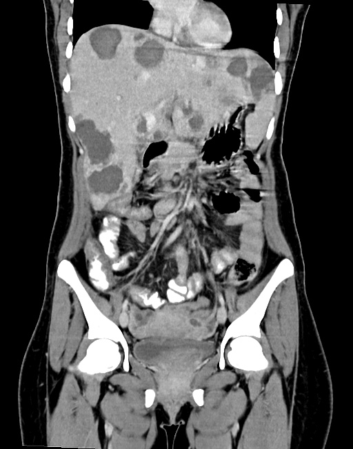 Choriocarcinoma liver metastases (Radiopaedia 74768-85766 B 47).jpg