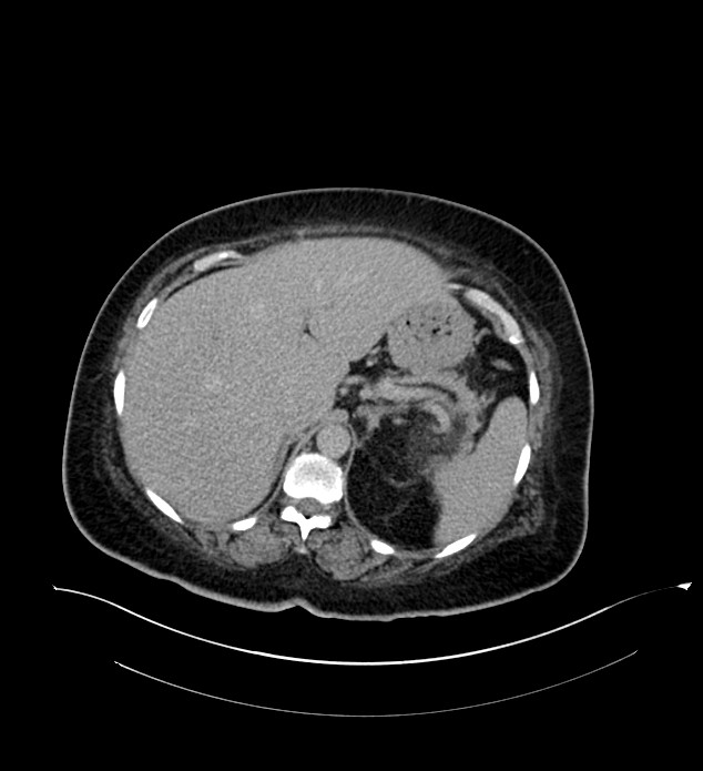 Chromophobe renal cell carcinoma (Radiopaedia 84239-99519 E 47).jpg