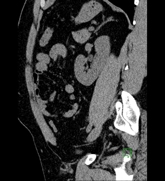 Chromophobe renal cell carcinoma (Radiopaedia 84286-99573 C 58).jpg