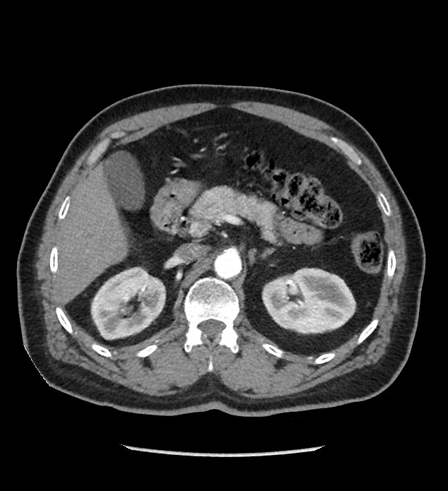 Chromophobe renal cell carcinoma (Radiopaedia 86879-103083 B 48).jpg
