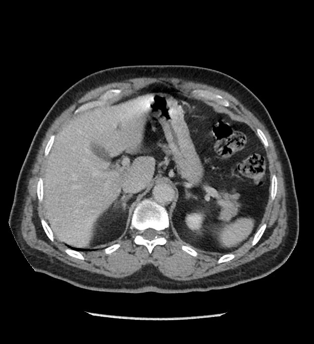 Chromophobe renal cell carcinoma (Radiopaedia 86879-103083 C 32).jpg