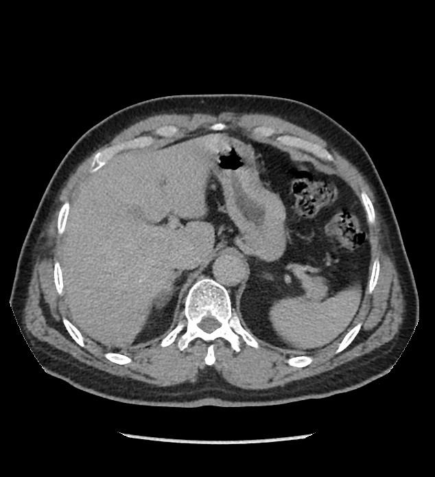 Chromophobe renal cell carcinoma (Radiopaedia 86879-103083 D 28).jpg