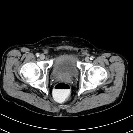 Chronic appendicitis complicated by appendicular abscess, pylephlebitis and liver abscess (Radiopaedia 54483-60700 B 139).jpg