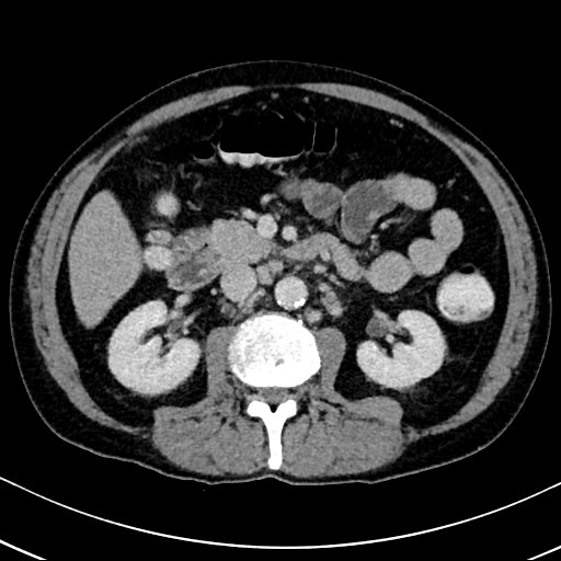 Chronic appendicitis complicated by appendicular abscess, pylephlebitis and liver abscess (Radiopaedia 54483-60700 B 69).jpg