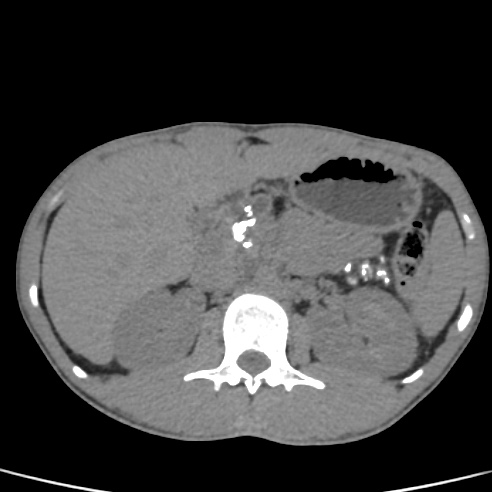 File:Chronic calcific pancreatitis (Radiopaedia 56280-62953 Axial non-contrast 15).jpg