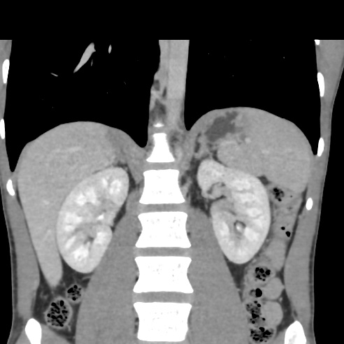 File:Chronic calcific pancreatitis (Radiopaedia 56280-62953 F 19).jpg