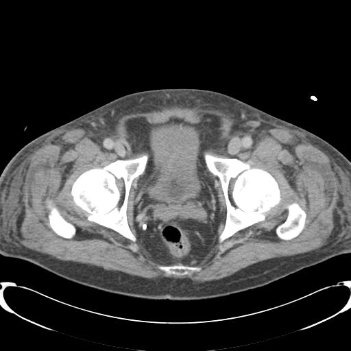 Chronic diverticulitis complicated by hepatic abscess and portal vein thrombosis (Radiopaedia 30301-30938 A 87).jpg