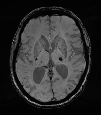 Chronic hypertensive encephalopathy (Radiopaedia 39993-42482 Axial SWI 46).png