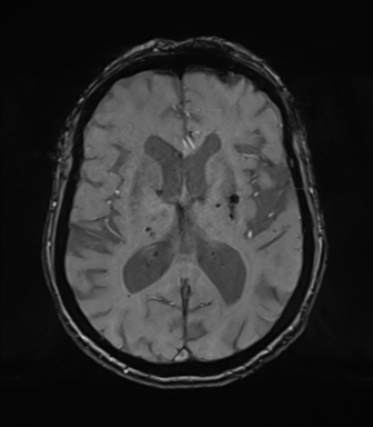 Chronic hypertensive encephalopathy (Radiopaedia 72844-83495 Axial SWI magnitude 46).png