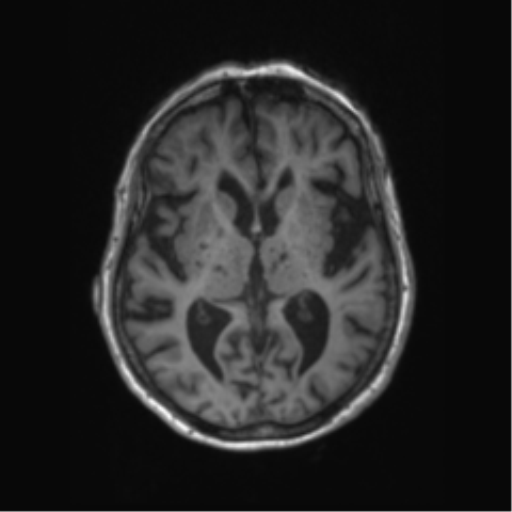 Chronic hypertensive encephalopathy (Radiopaedia 72844-83495 Axial T1 37).png