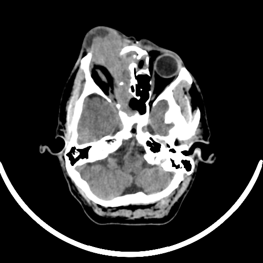 Chronic invasive fungal sinusitis with intraorbital and intracranial extension (Radiopaedia 56387-63046 Axial non-contrast 123).jpg