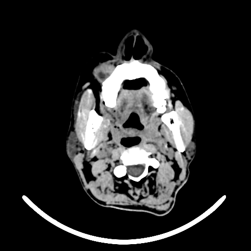 File:Chronic invasive fungal sinusitis with intraorbital and intracranial extension (Radiopaedia 56387-63046 Axial non-contrast 17).jpg