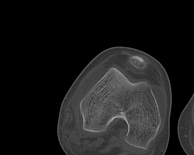 File:Chronic ostemyelitis of the femur with long sinus tract (Radiopaedia 74947-85982 Axial bone window 218).jpg