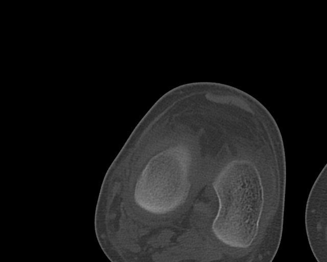 Chronic ostemyelitis of the femur with long sinus tract (Radiopaedia 74947-85982 Axial bone window 226).jpg