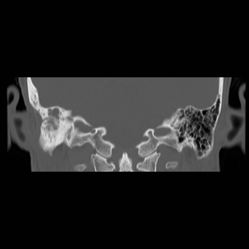 File:Chronic otomastoiditis (Radiopaedia 27138-27309 Coronal bone window 15).jpg