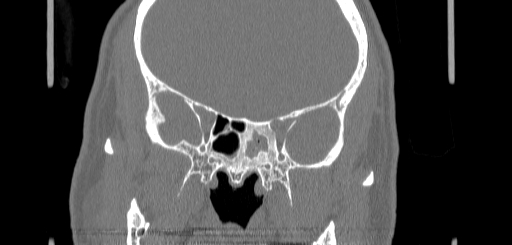 Chronic sphenoidal sinusitis (Radiopaedia 62030-70122 Coronal bone window 106).jpg
