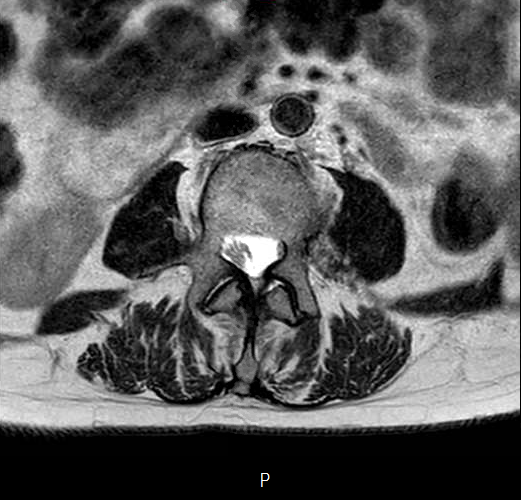 File:Chronic spinal hematoma with cauda equina syndrome (Radiopaedia 75745-87090 Axial T2 7).png