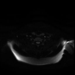 Chronic submandibular sialadenitis (Radiopaedia 61852-69885 Axial DWI 23).jpg
