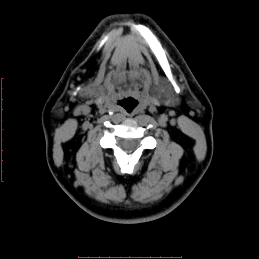 Chronic submandibular sialolithiasis (Radiopaedia 69817-79814 Axial non-contrast 115).jpg