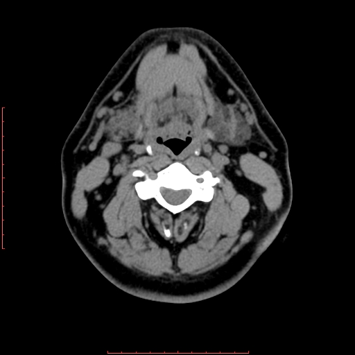 Chronic submandibular sialolithiasis (Radiopaedia 69817-79814 Axial non-contrast 124).jpg