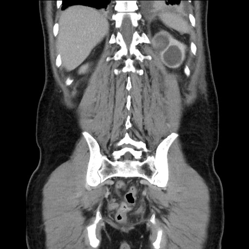Chronic ureteropelvic junction obstruction (Radiopaedia 78365-90996 B 80).jpg