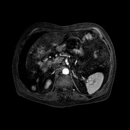 Cirrhosis and hepatocellular carcinoma in the setting of hemochromatosis (Radiopaedia 75394-86594 Axial T1 C+ fat sat 129).jpg