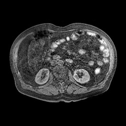 Cirrhosis and hepatocellular carcinoma in the setting of hemochromatosis (Radiopaedia 75394-86594 Axial T1 C+ fat sat 14).jpg