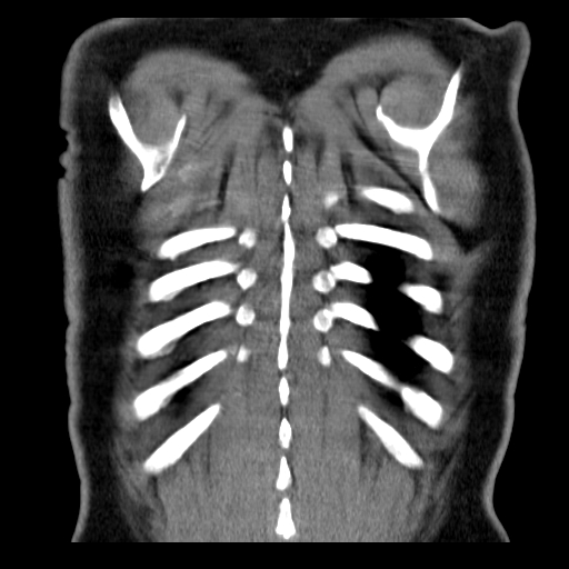 File:Classic complicated silicosis (Radiopaedia 49720-54961 Coronal liver window 59).jpg