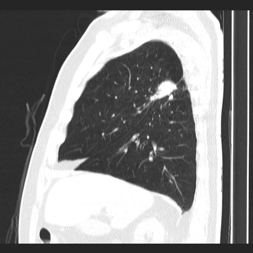 Classic complicated silicosis (Radiopaedia 49720-54961 Sagittal lung window 45).jpg