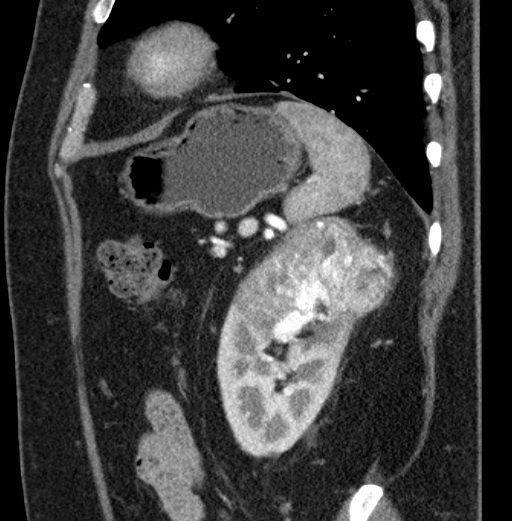 File:Clear cell renal cell carcinoma (Radiopaedia 61449-69393 D 18).jpg