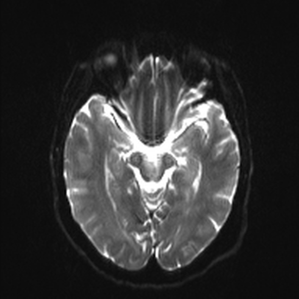 File:Clival meningioma (Radiopaedia 53278-59248 Axial DWI 10).jpg