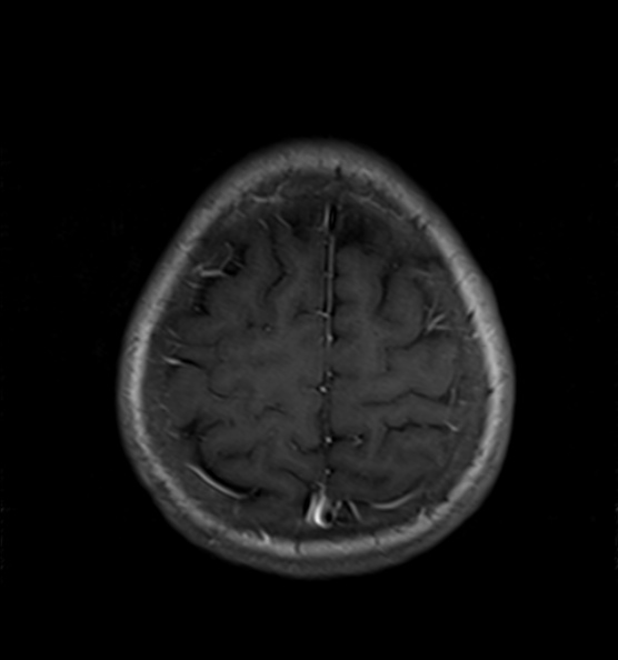 File:Clival meningioma (Radiopaedia 53278-59248 Axial T1 C+ 21).jpg