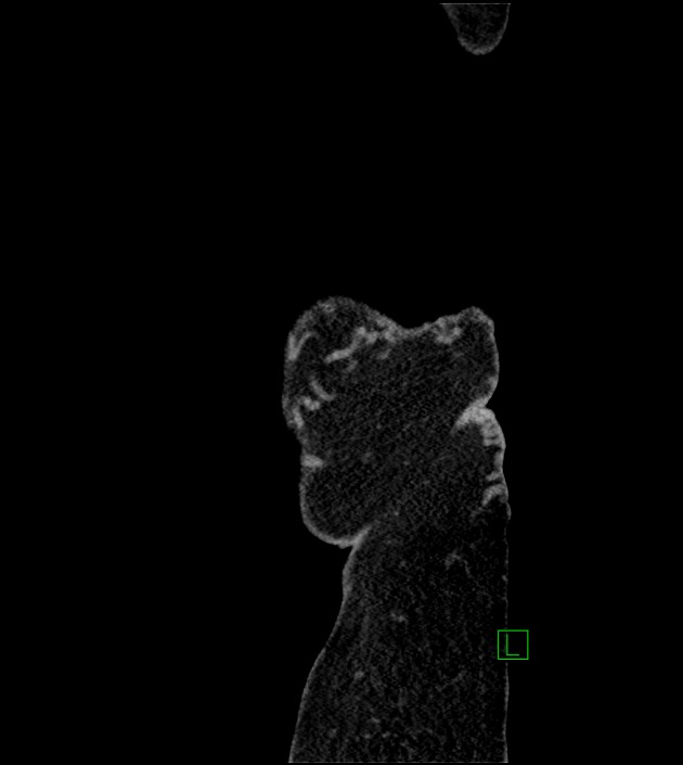 Closed-loop small bowel obstruction-internal hernia (Radiopaedia 78439-91096 C 143).jpg