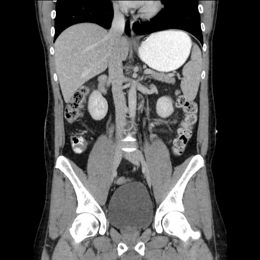 File:Closed-loop small bowel obstruction (Radiopaedia 73713-84509 C 67).jpg