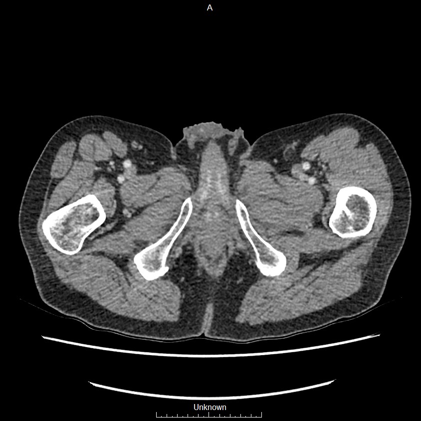 Closed loop bowel obstruction and ischemia (Radiopaedia 86959-103180 A 99).jpg