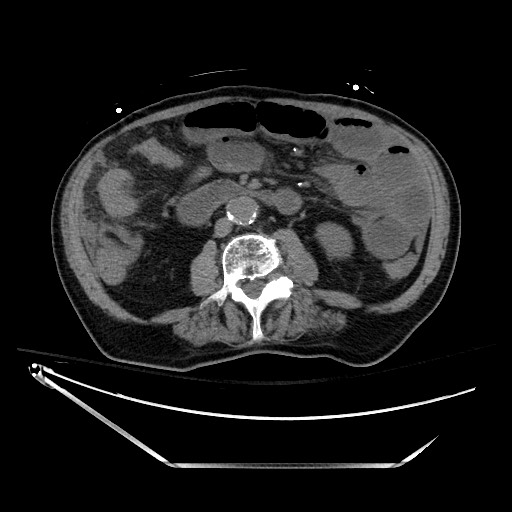 Closed loop obstruction due to adhesive band, resulting in small bowel ischemia and resection (Radiopaedia 83835-99023 Axial non-contrast 79).jpg