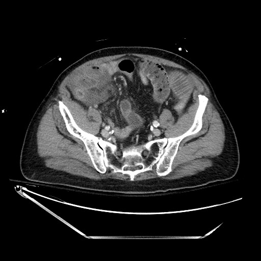 Closed loop obstruction due to adhesive band, resulting in small bowel ischemia and resection (Radiopaedia 83835-99023 D 118).jpg