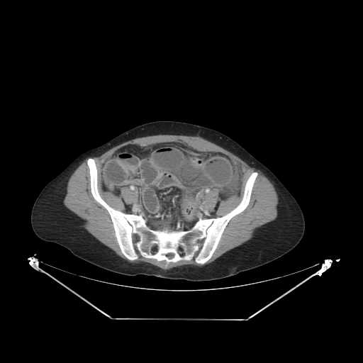 Closed loop small bowel obstruction (Radiopaedia 68471-78022 A 31).jpg