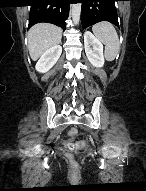 Closed loop small bowel obstruction - adhesions (Radiopaedia 59078-66369 B 91).jpg