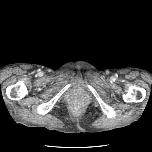 Closed loop small bowel obstruction - adhesions and infarct (Radiopaedia 85125-100678 B 117).jpg